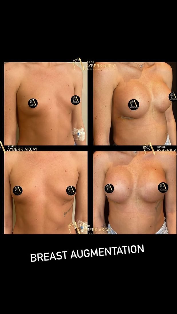 Breast augmentation before and after from two angles