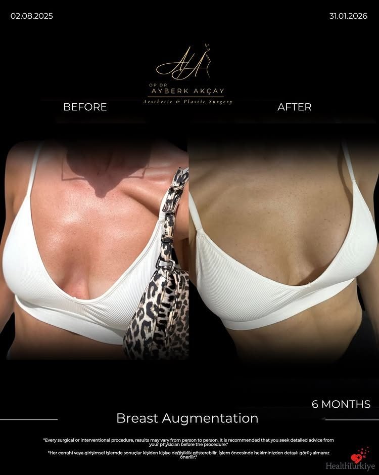 Breast augmentation before and after at six months