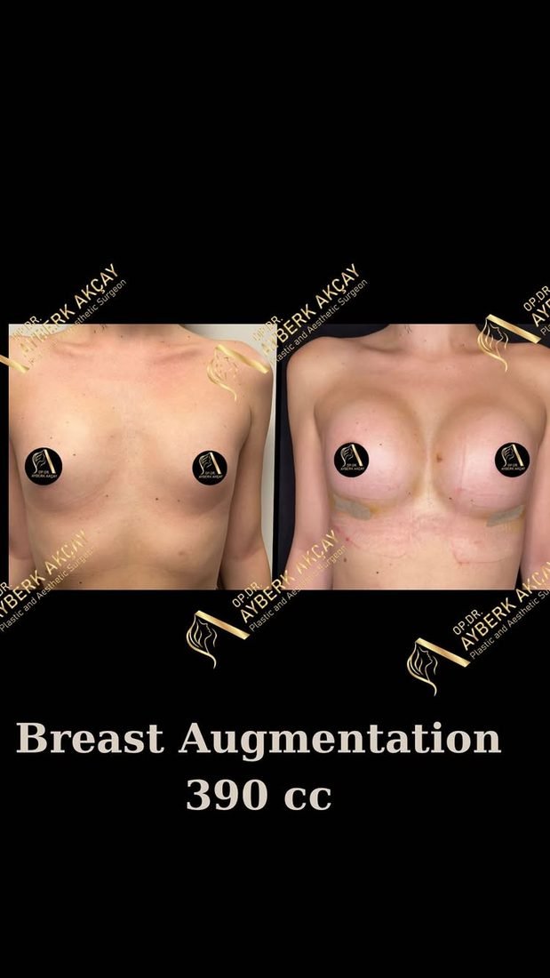 Breast augmentation with 390 cc implants, photographed immediately after surgery with surgical tape