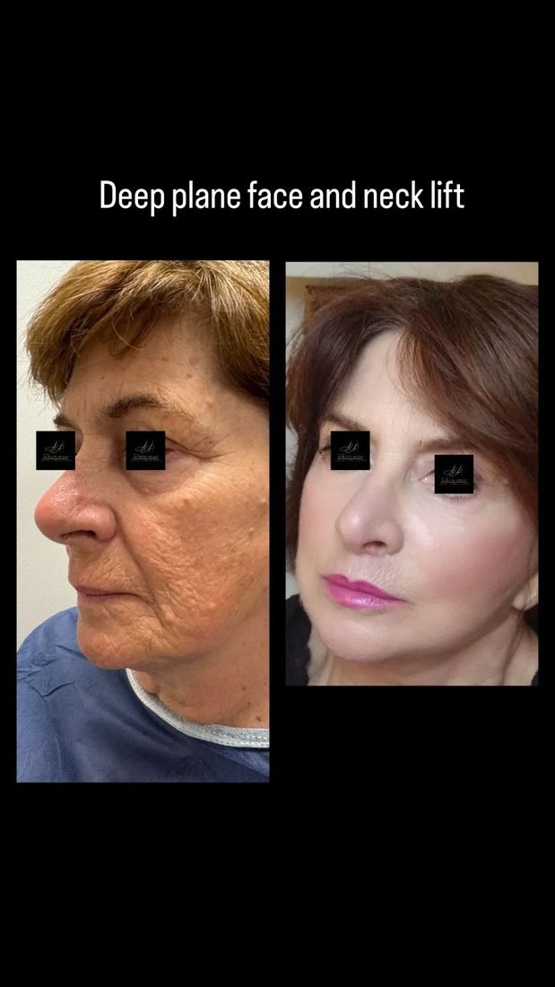 Deep plane face and neck lift before and after — three-quarter profile, older patient
