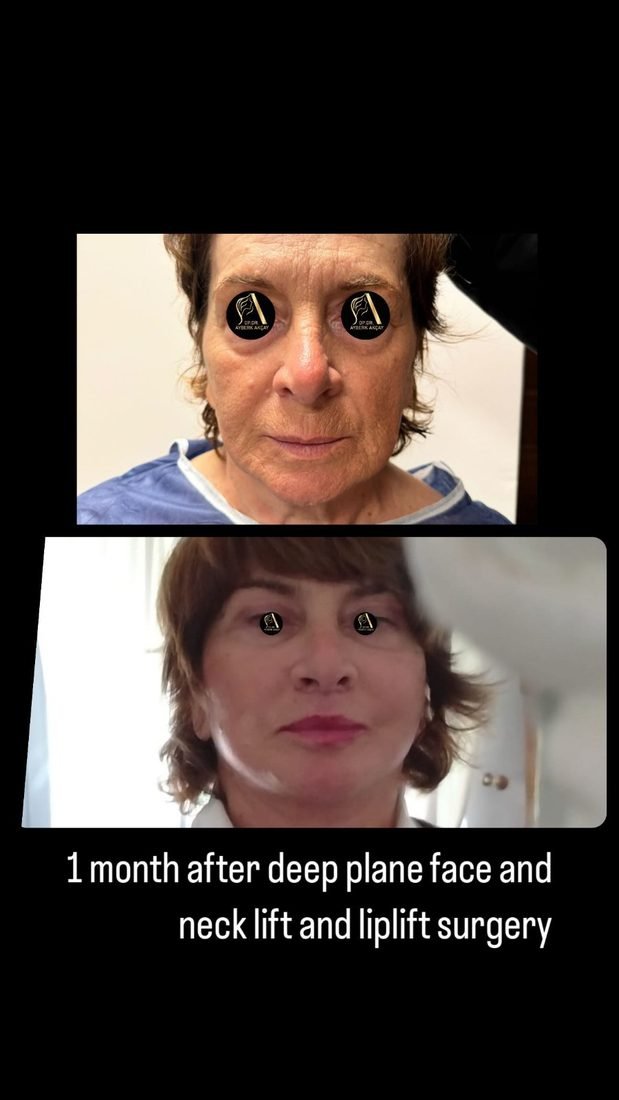 One month after deep plane face and neck lift with lip lift — a casual photo, still settling