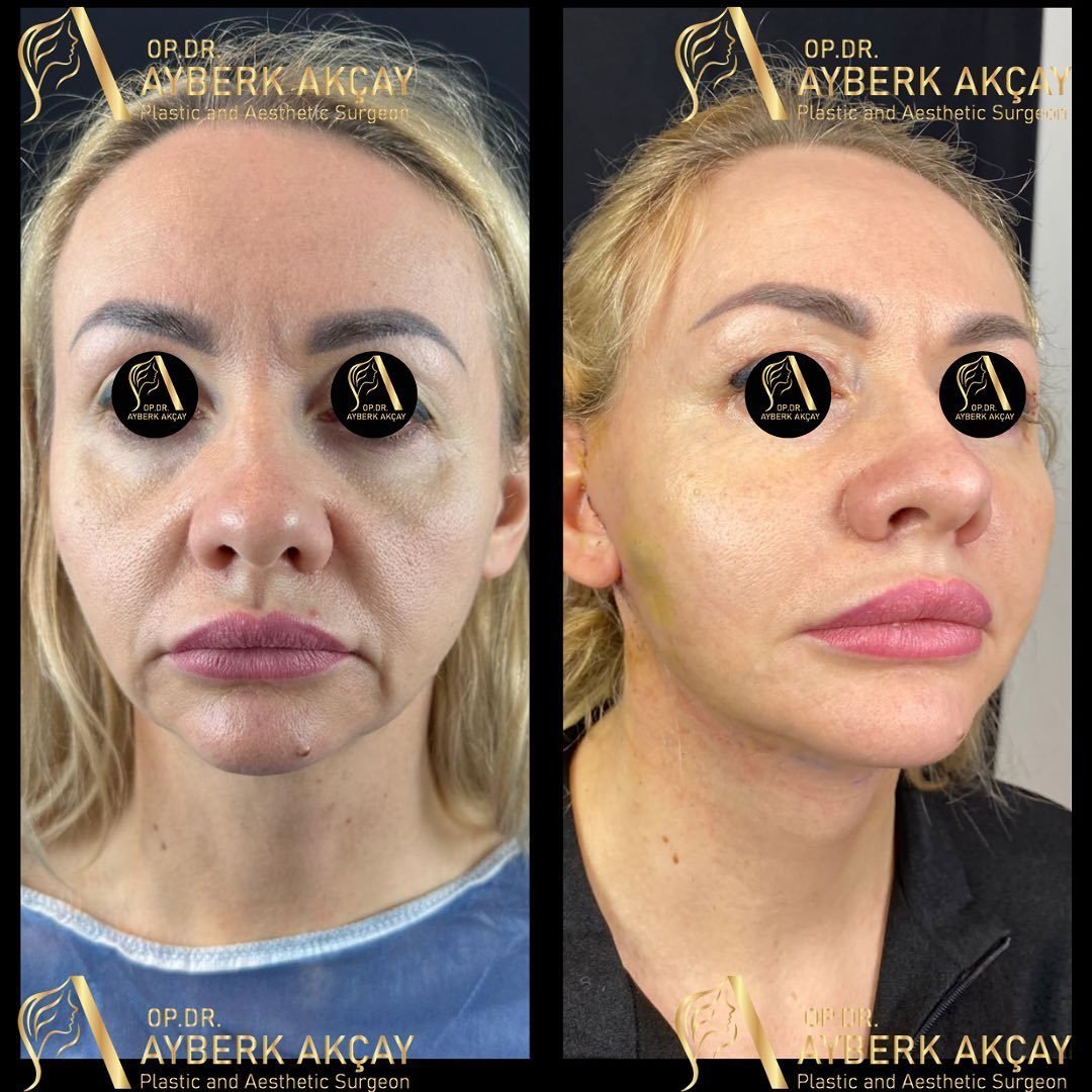 Deep plane face and neck lift before and after — healed, jawline restored