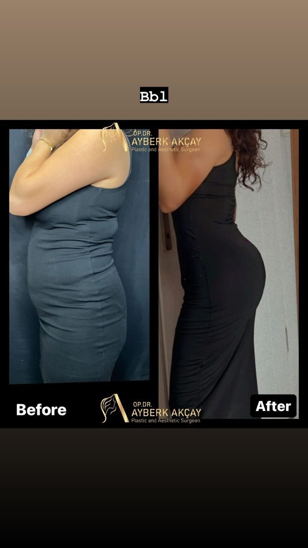 Fat transfer before and after, healed side profile in a black dress