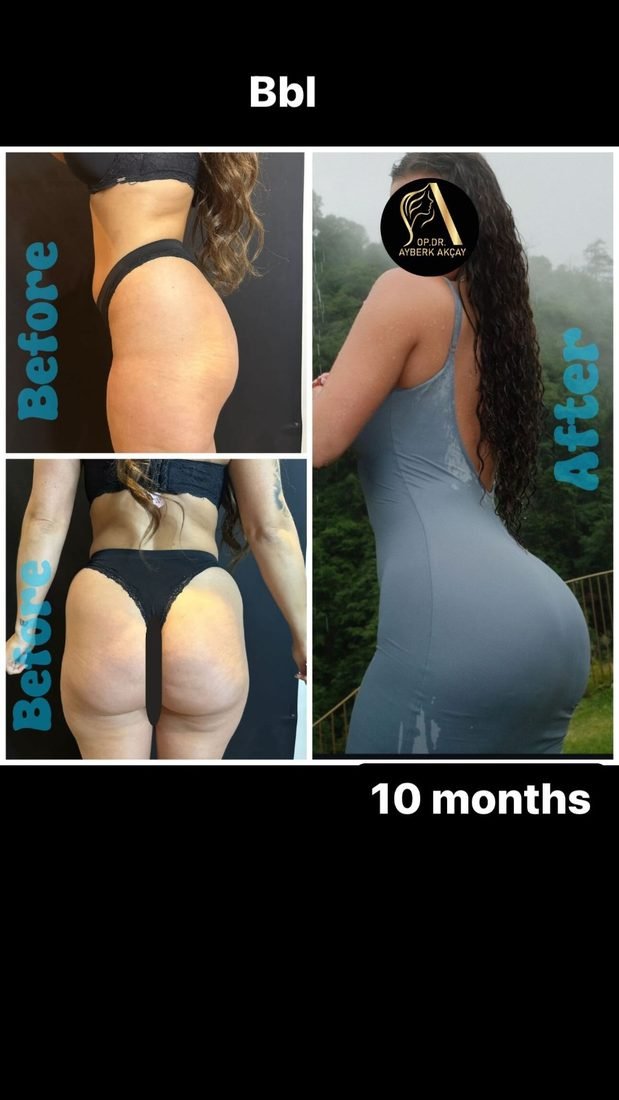 Liposuction with fat transfer before and after at ten months, the after photographed outdoors