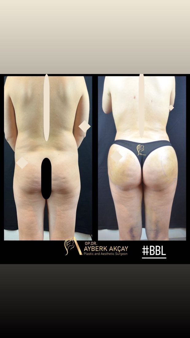 Body contouring around ten days after surgery, bruising still visible, an honest healing stage