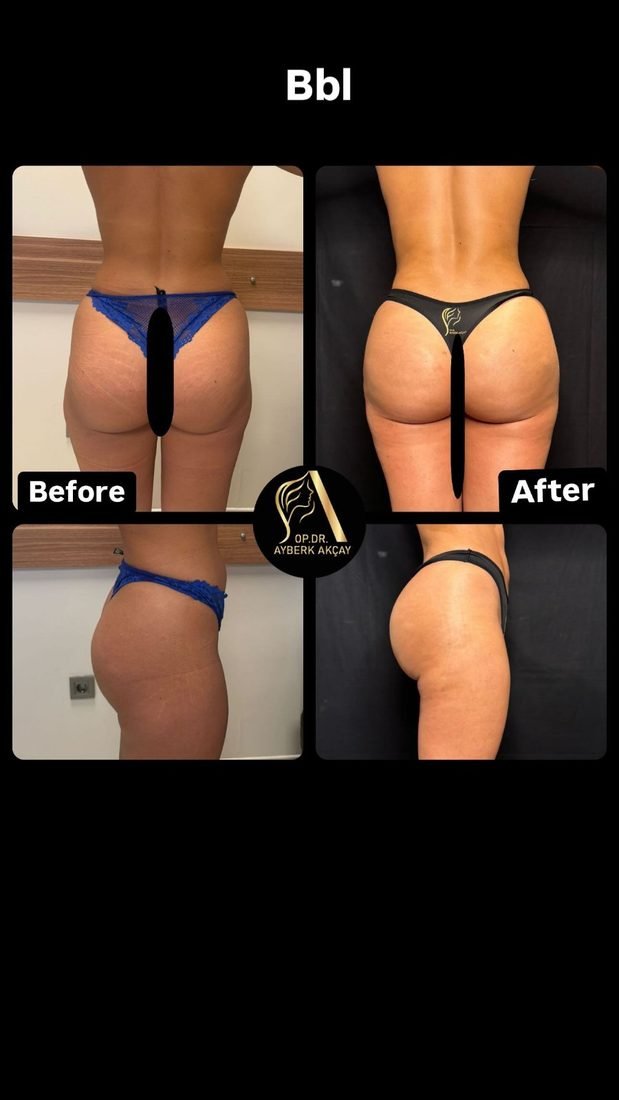 Liposuction with fat transfer before and after, healed result, two angles