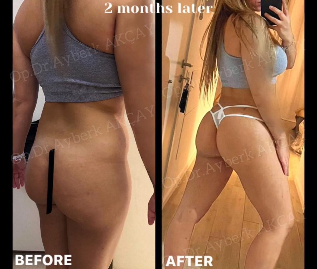 Before and after at two months, the after is the patient's own mirror photo