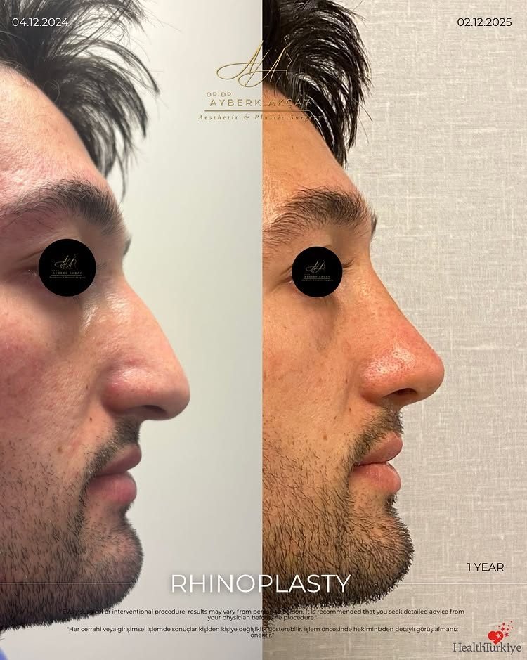 Rhinoplastik bei einem Mann, vorher und nachher, ein Jahr danach