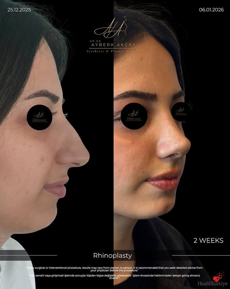 Rinoplastia dos semanas después de la cirugía, cicatrización aún en curso