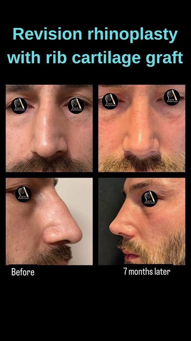 Revision rhinoplasty with rib cartilage graft, seven months, four views