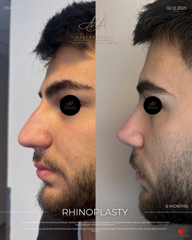 Male rhinoplasty before and after, six months