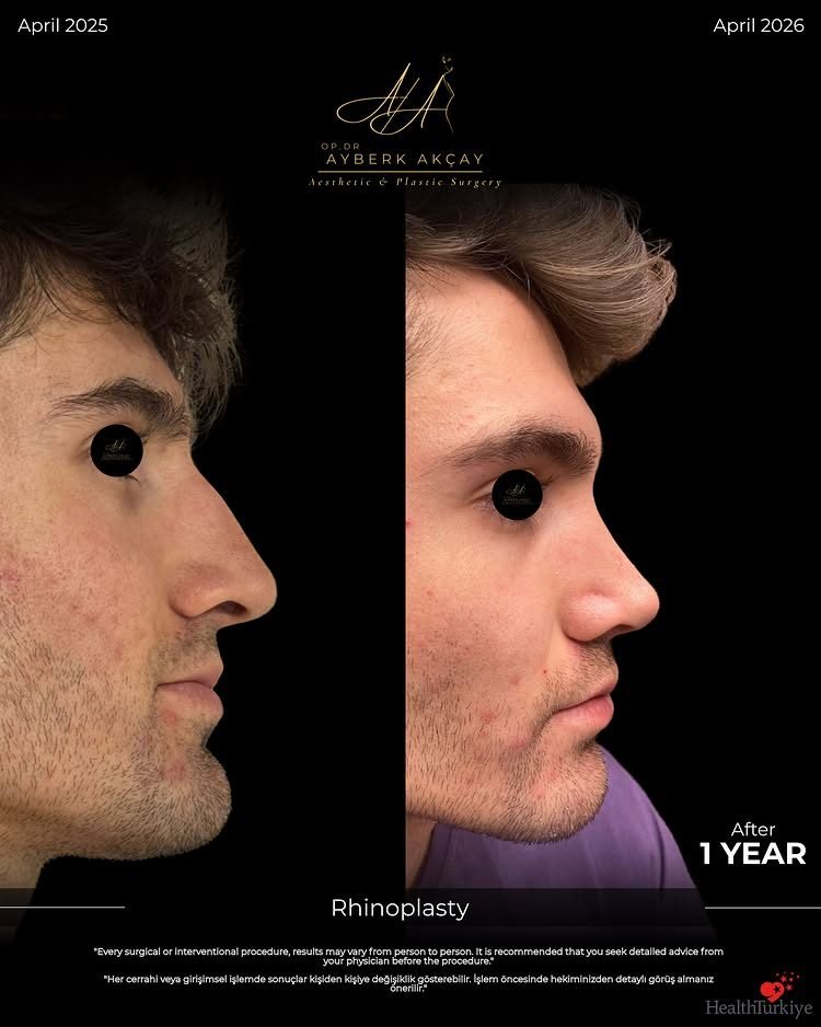 Rhinoplasty before and after at one year — side profile, dorsal hump removed