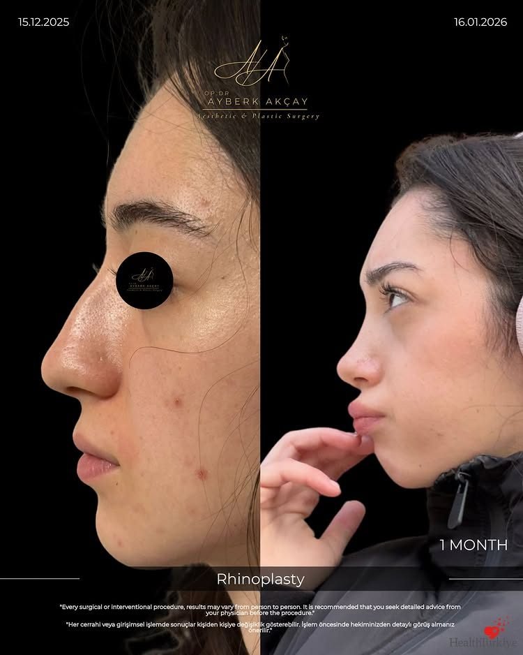 Rinoplastia antes y después, un mes
