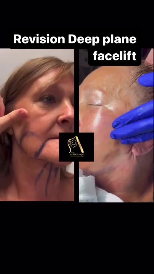 Surgical footage poster: revision deep plane facelift in the operating room (graphic)