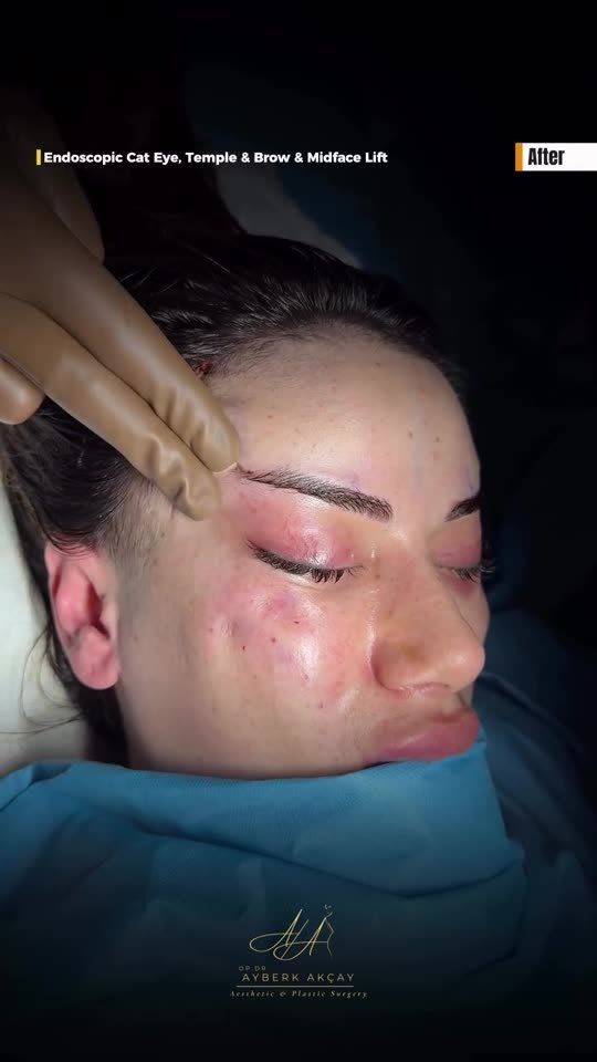 Surgical footage poster: endoscopic cat-eye, temple and brow lift (graphic)