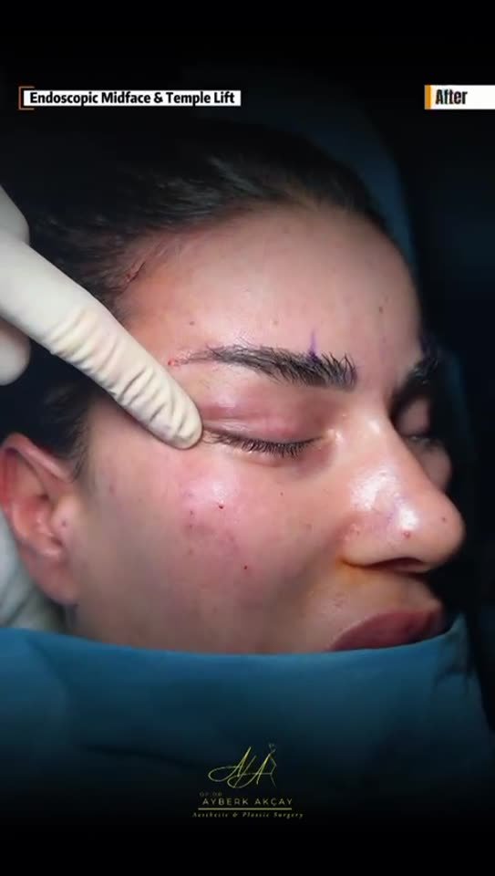 Surgical footage poster: endoscopic midface and temple lift (graphic)