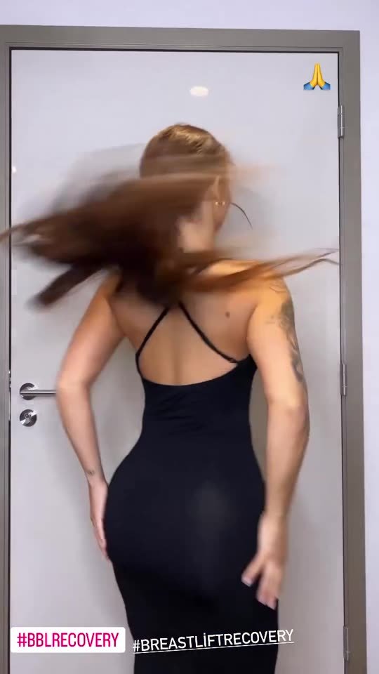 Video: a healed body contouring result shown from three angles