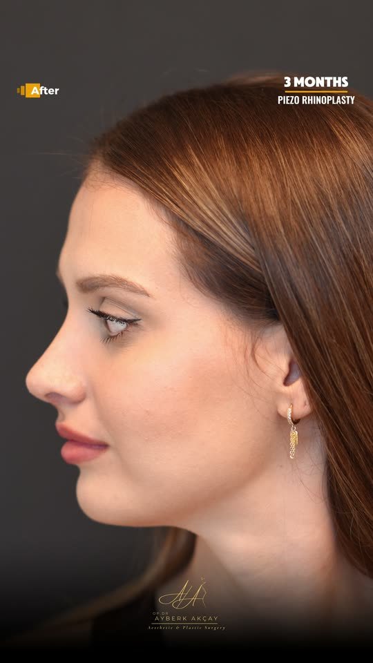 Patient three months after ultrasonic rhinoplasty, profile view in motion